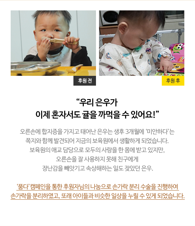 
                        “우리 은우가 
                            이제 혼자서도 귤을 까먹을 수 있어요!”
                            오른손에 합지증을 가지고 태어난 은우는 생후 3개월에 ‘미안하다’는 
                            쪽지와 함께 발견되어 지금의 보육원에서 생활하게 되었습니다. 
                            보육원의 애교 담당으로 모두의 사랑을 한 몸에 받고 있지만, 
                            오른손을 잘 사용하지 못해 친구에게 
                            장난감을 빼앗기고 속상해하는 일도 잦았던 은우.

                            ‘품다’캠페인을 통한 후원자님의 나눔으로 손가락 분리 수술을 진행하여 
                            손가락을 분리하였고, 또래 아이들과 비슷한 일상을 누릴 수 있게 되었습니다.

                        